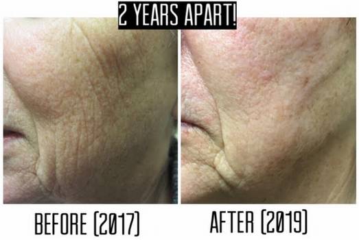 Dr Varano CO2 treatment Dr Varano CO2 treatment